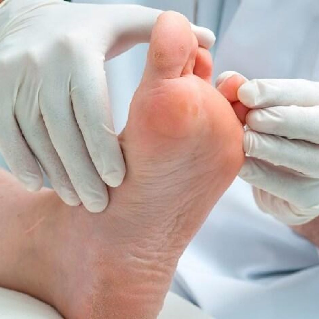 curso-com-certificado-de-pe-diabetico-tratamento-cuidados-e-complicacoes-1566927658-870-88eb20f5