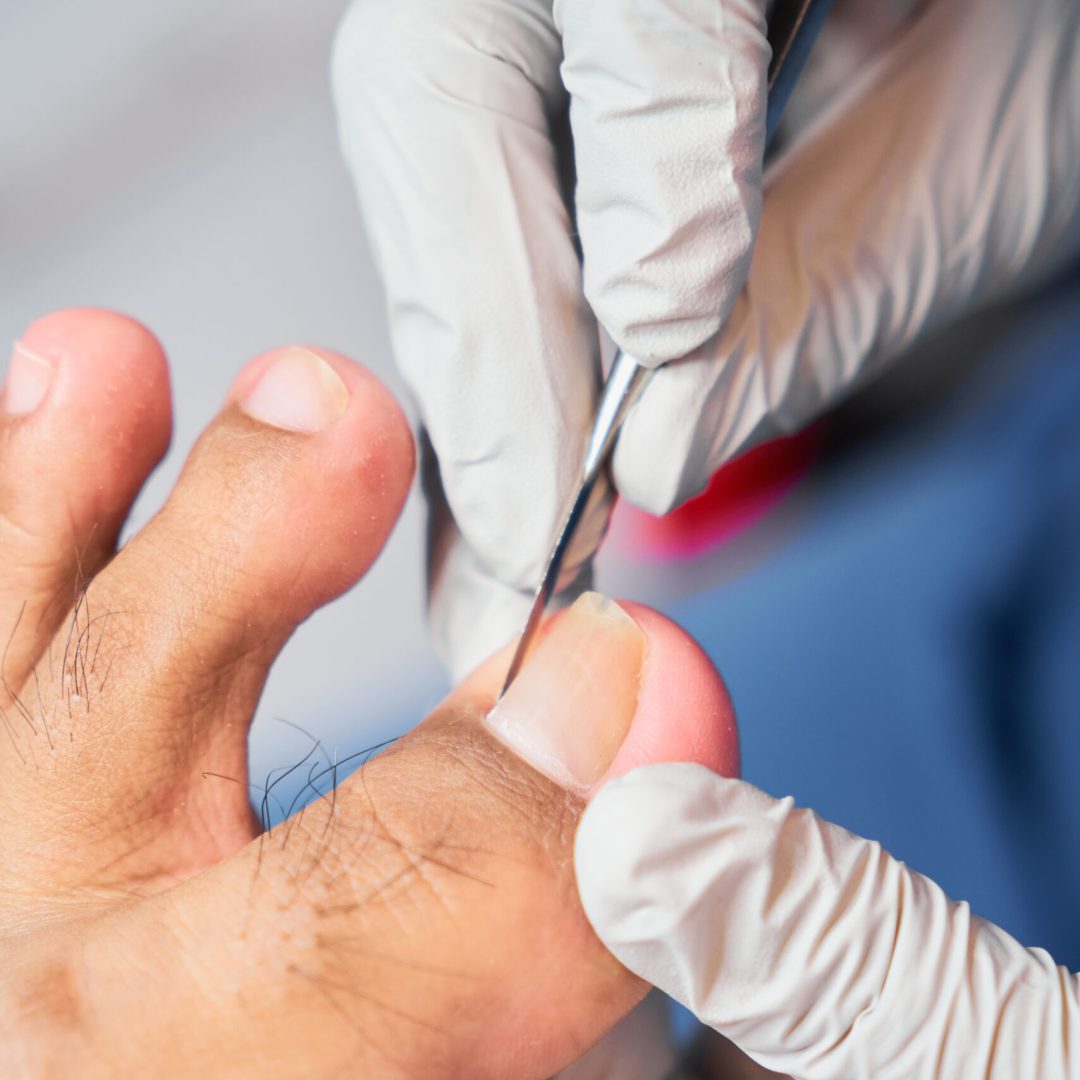 Podiatrist treating feet, concept chiropody